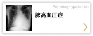 肺高血圧症 Pulmonary hypertension